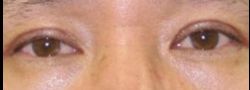 Asian Crease & Double Eyelid Surgery case #10566