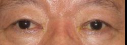 Asian Crease & Double Eyelid Surgery case #10569