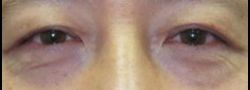 Asian Crease & Double Eyelid Surgery case #10572