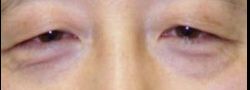 Asian Crease & Double Eyelid Surgery case #10572