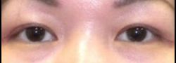 Asian Crease & Double Eyelid Surgery case #10575