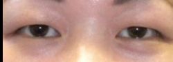 Asian Crease & Double Eyelid Surgery case #10575