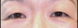 Asian Crease & Double Eyelid Surgery case #10578