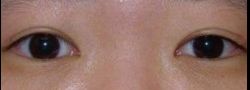 Asian Crease & Double Eyelid Surgery case #10597