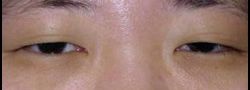 Asian Crease & Double Eyelid Surgery case #10597