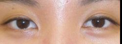 Asian Crease & Double Eyelid Surgery case #10600