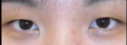 Asian Crease & Double Eyelid Surgery case #10600