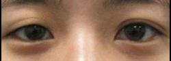 Asian Crease & Double Eyelid Surgery case #10541