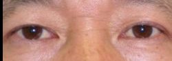 Asian Crease & Double Eyelid Surgery case #10603