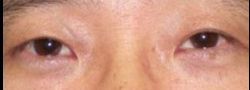 Asian Crease & Double Eyelid Surgery case #10606