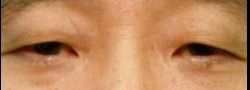 Asian Crease & Double Eyelid Surgery case #10606