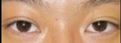 Asian Crease & Double Eyelid Surgery case #10610