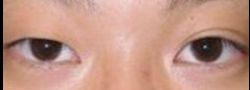 Asian Crease & Double Eyelid Surgery case #10610
