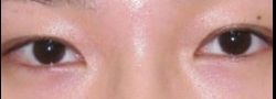 Asian Crease & Double Eyelid Surgery case #10613