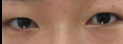 Asian Crease & Double Eyelid Surgery case #10613