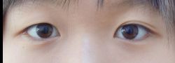 Asian Crease & Double Eyelid Surgery case #10616