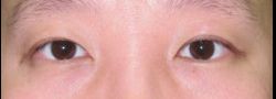 Asian Crease & Double Eyelid Surgery case #10622