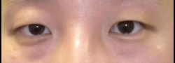 Asian Crease & Double Eyelid Surgery case #10622
