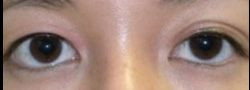 Asian Crease & Double Eyelid Surgery case #10625