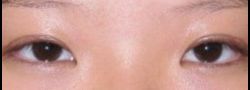 Asian Crease & Double Eyelid Surgery case #10628