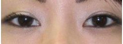 Asian Crease & Double Eyelid Surgery case #10631