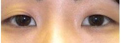 Asian Crease & Double Eyelid Surgery case #10631