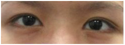 Asian Crease & Double Eyelid Surgery case #10634