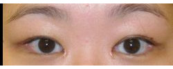 Asian Crease & Double Eyelid Surgery case #10640