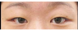 Asian Crease & Double Eyelid Surgery case #10640