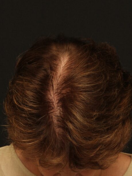 Hair Restoration case #11214