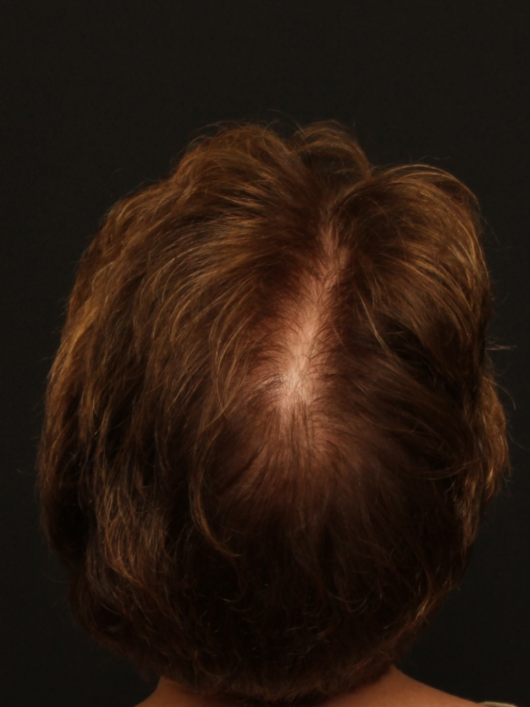 Hair Restoration case #11214