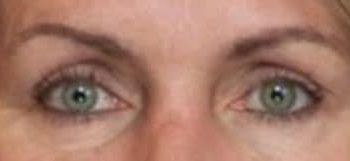 Upper Eyelid Blepharoplasty case #10918