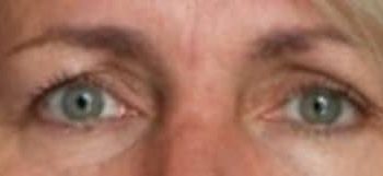 Upper Eyelid Blepharoplasty case #10918