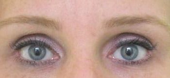 Brow Lift case #10940