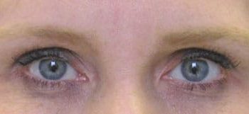 Brow Lift case #10940