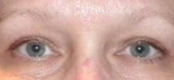 Brow Lift case #10943