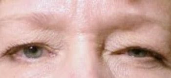 Brow Lift case #10943