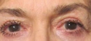 Brow Lift case #10946