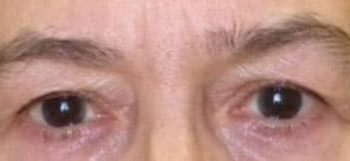 Brow Lift case #10946