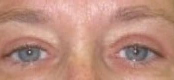 Brow Lift case #10937