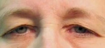Brow Lift case #10937