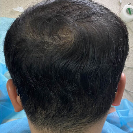 Hair Restoration case #11859