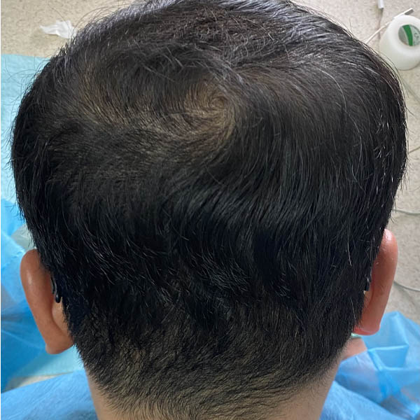 Hair Restoration case #11859