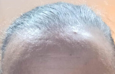 Hair Restoration case #11874