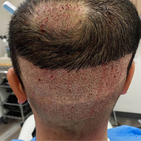 Hair Restoration case #11859