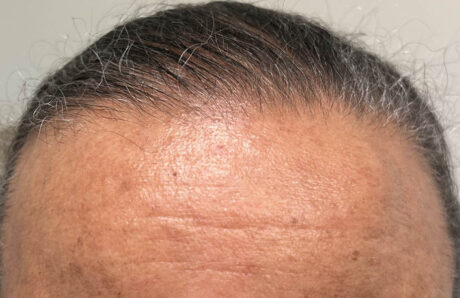 Hair Restoration case #11874