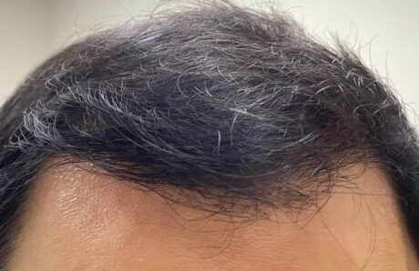 Hair Restoration case #11871