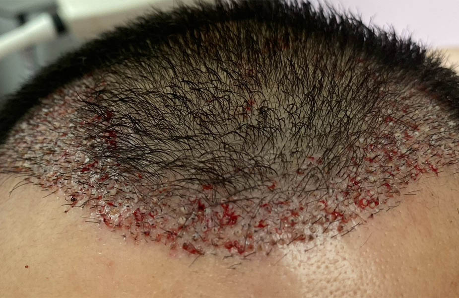 Hair Restoration case #11871