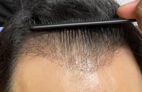 Hair Restoration case #11871