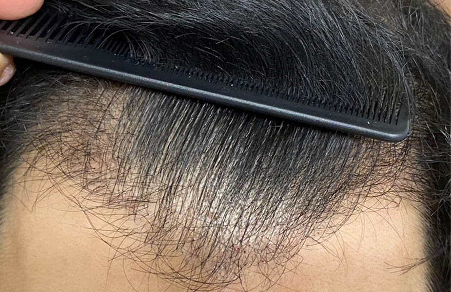 Hair Restoration case #11871